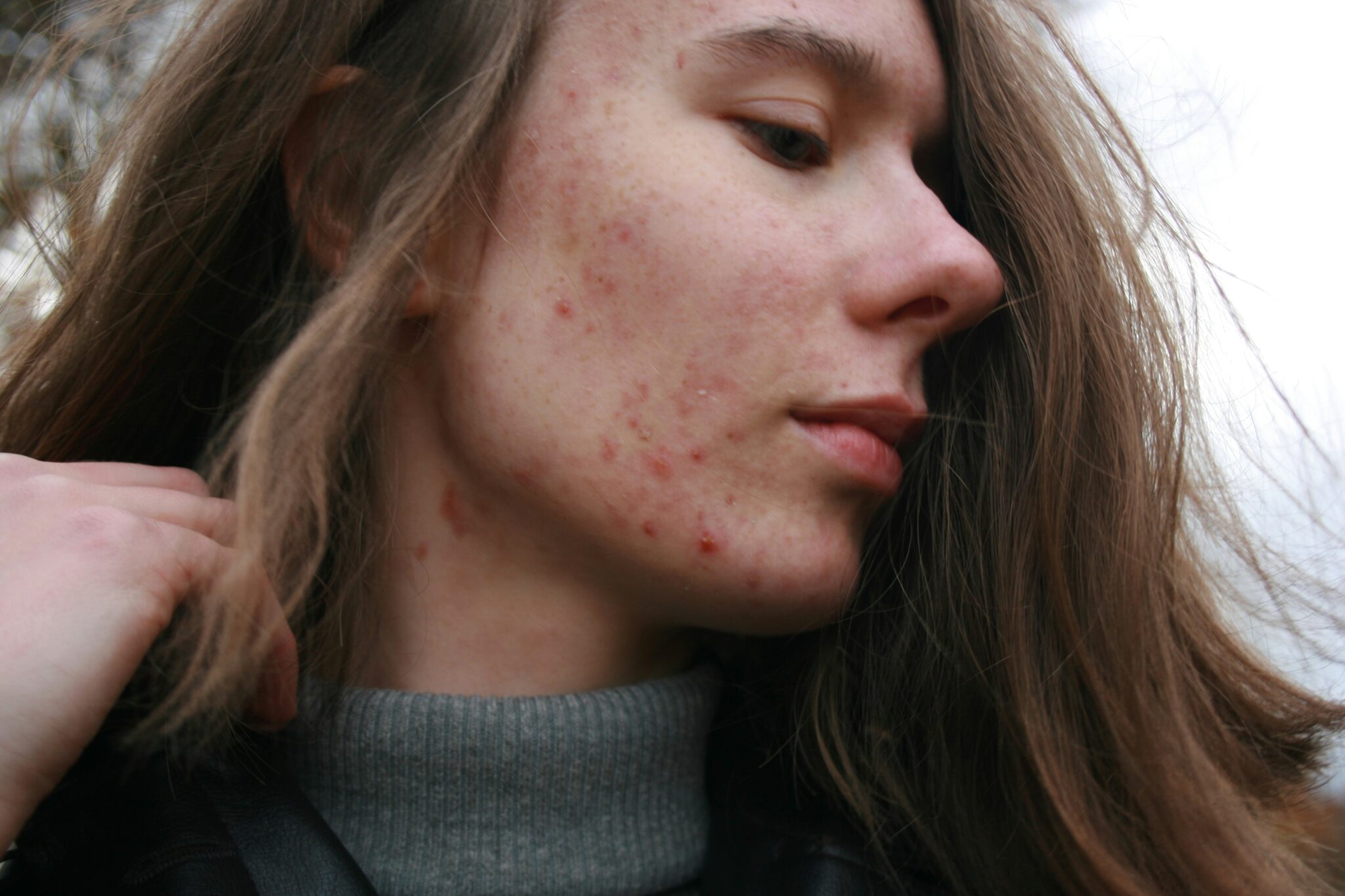 ontstekingen door acne